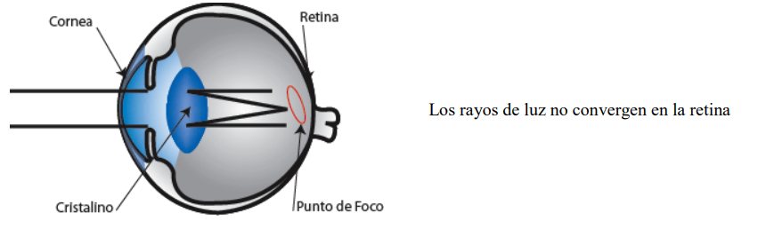 Diagram of an astigmatic eye: light rays do not converge at a single point on the retina