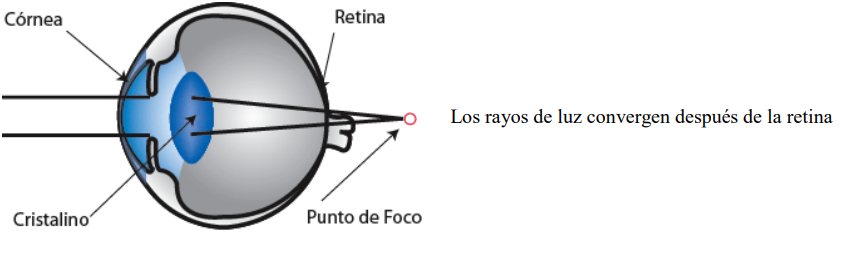 Diagram of a hyperopic eye: light rays converge behind the retina