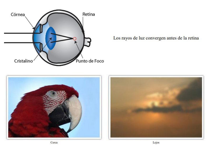 Diagram of a myopic eye: light rays converge before reaching the retina